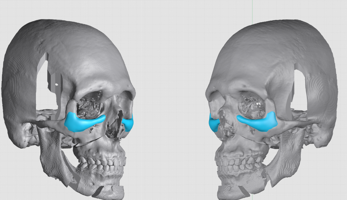 Infraorbital 45 view