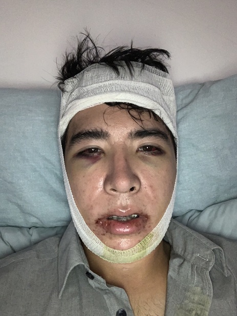 3rd day post op