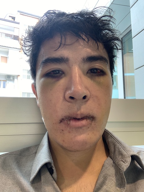 4th day post op