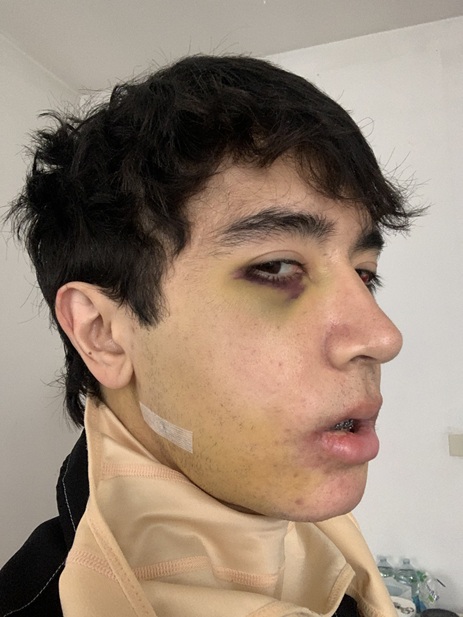 5th day post op