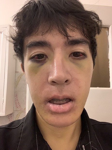 9th day post op