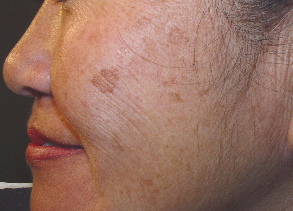 Hyperpigmentation
