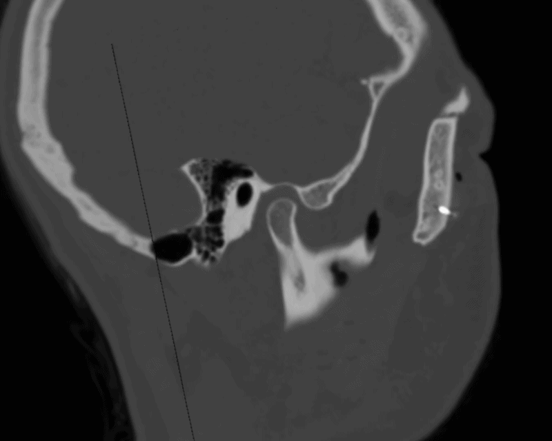 Condyle sag