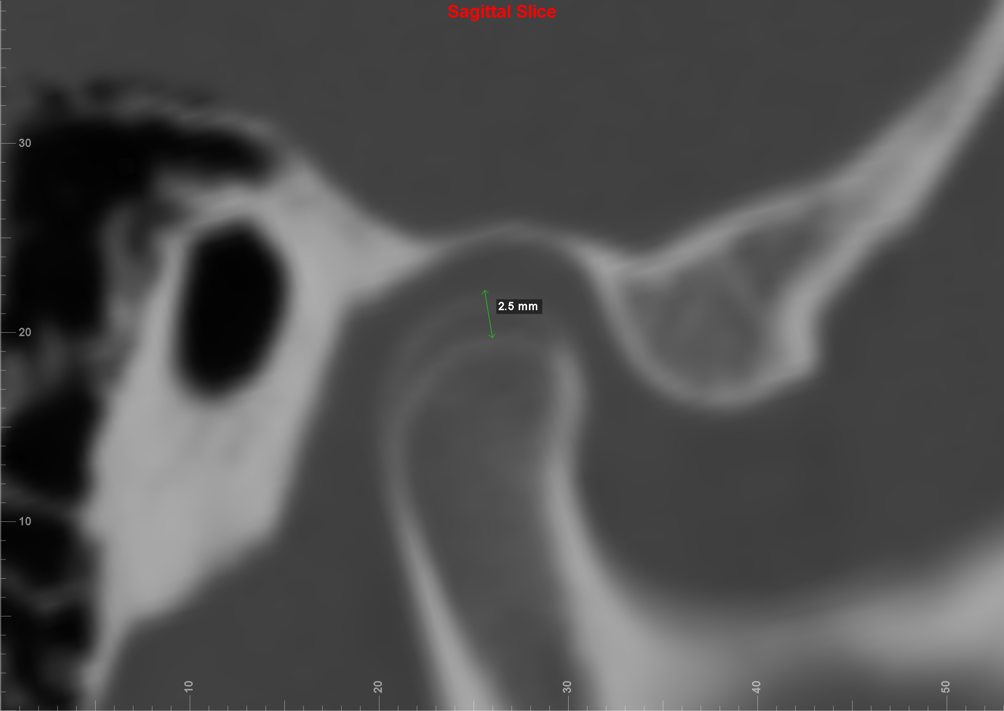 L Condyle Measurement