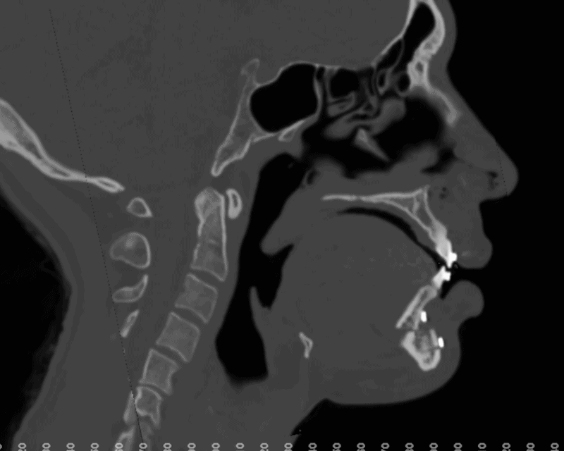 Sagittal superimposition