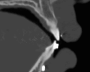 Incisors angle change