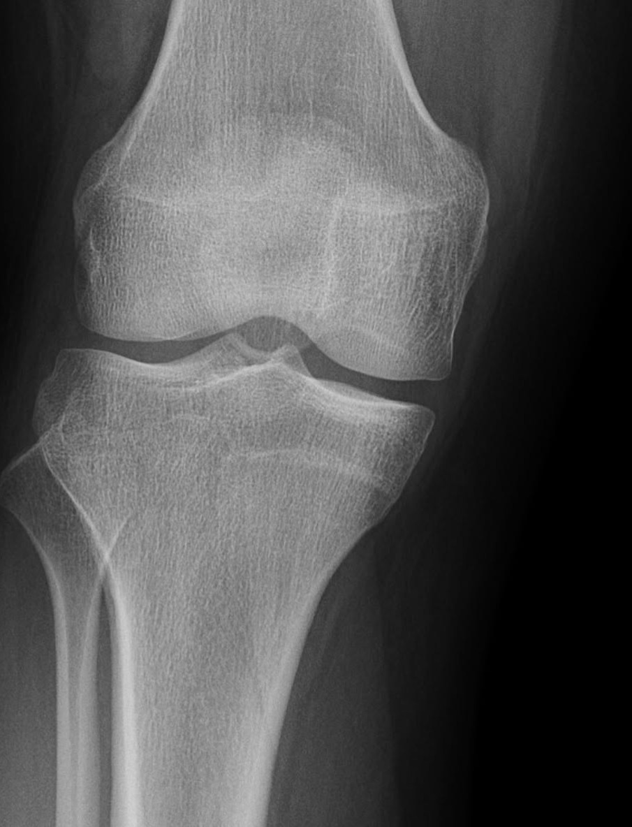 July 3 Knee Xray