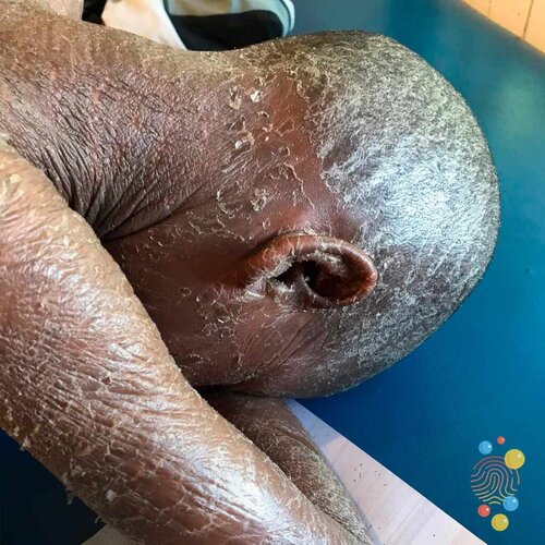 D178c-Ichthyosis-1024x1024.jpg