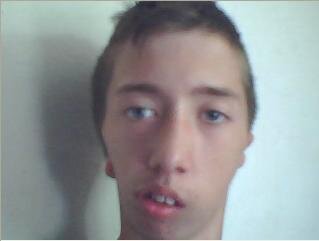 Bialateral_hemifacial_microsomia.jpeg