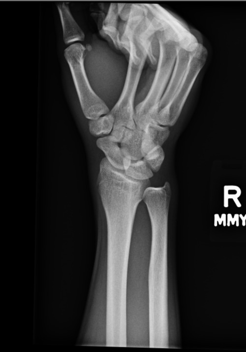 wrist2.png