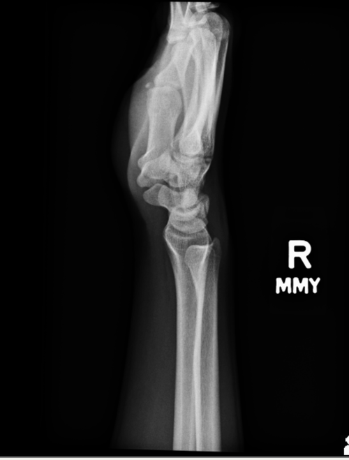 wrist3.png