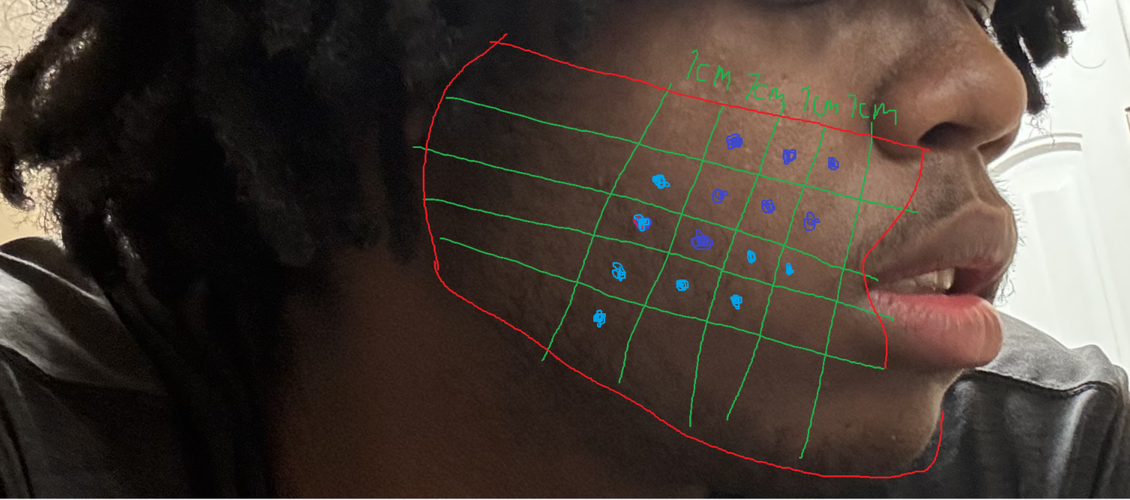 Fat dissolving Grid.png