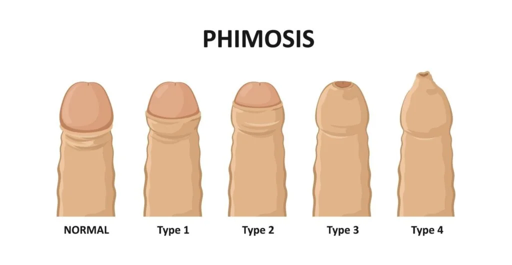 Phimosis types 1024x530