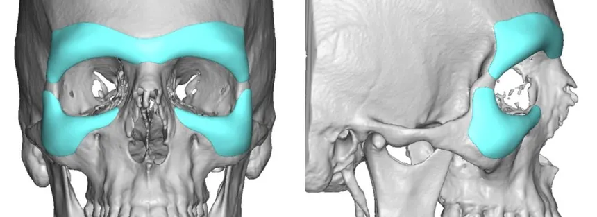 4 Custom male brow bone implants combined withj infraorbital implants design 1024x373