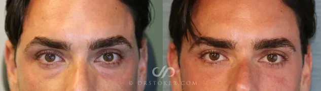 Undereye fillers 1596 view 1 thumbnail