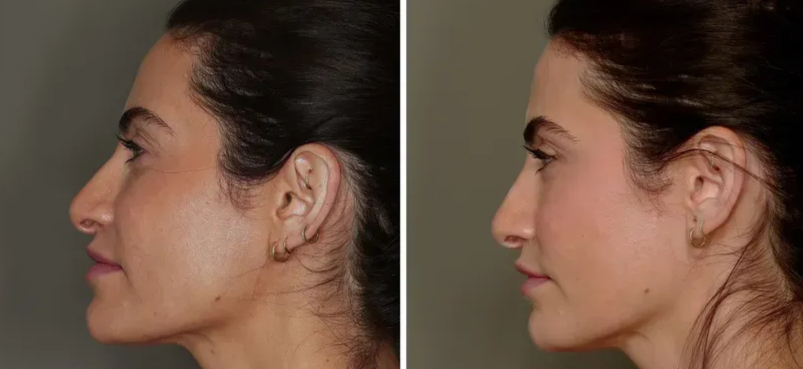 Allure facial fat grafting ba profile