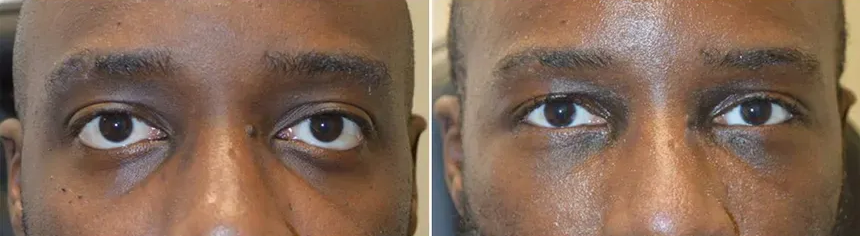 Cosmetic Orbital Decompression Before and After Front View Patient 1 Dr Taban