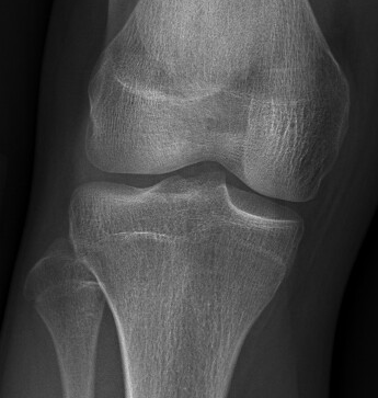 Knee 1