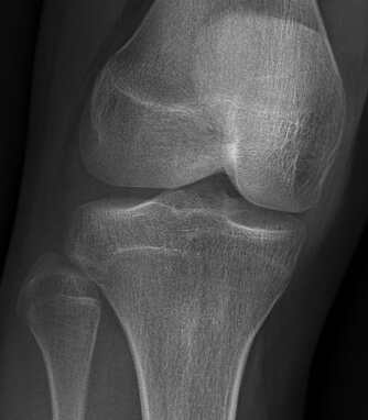 Knee 2