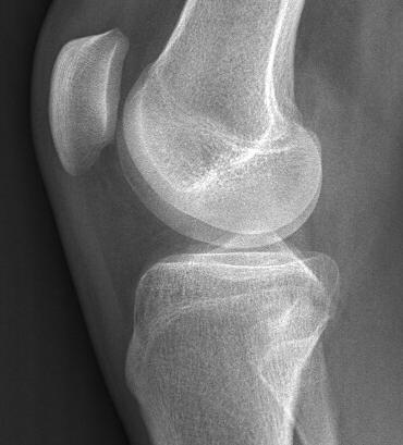 Knee 3