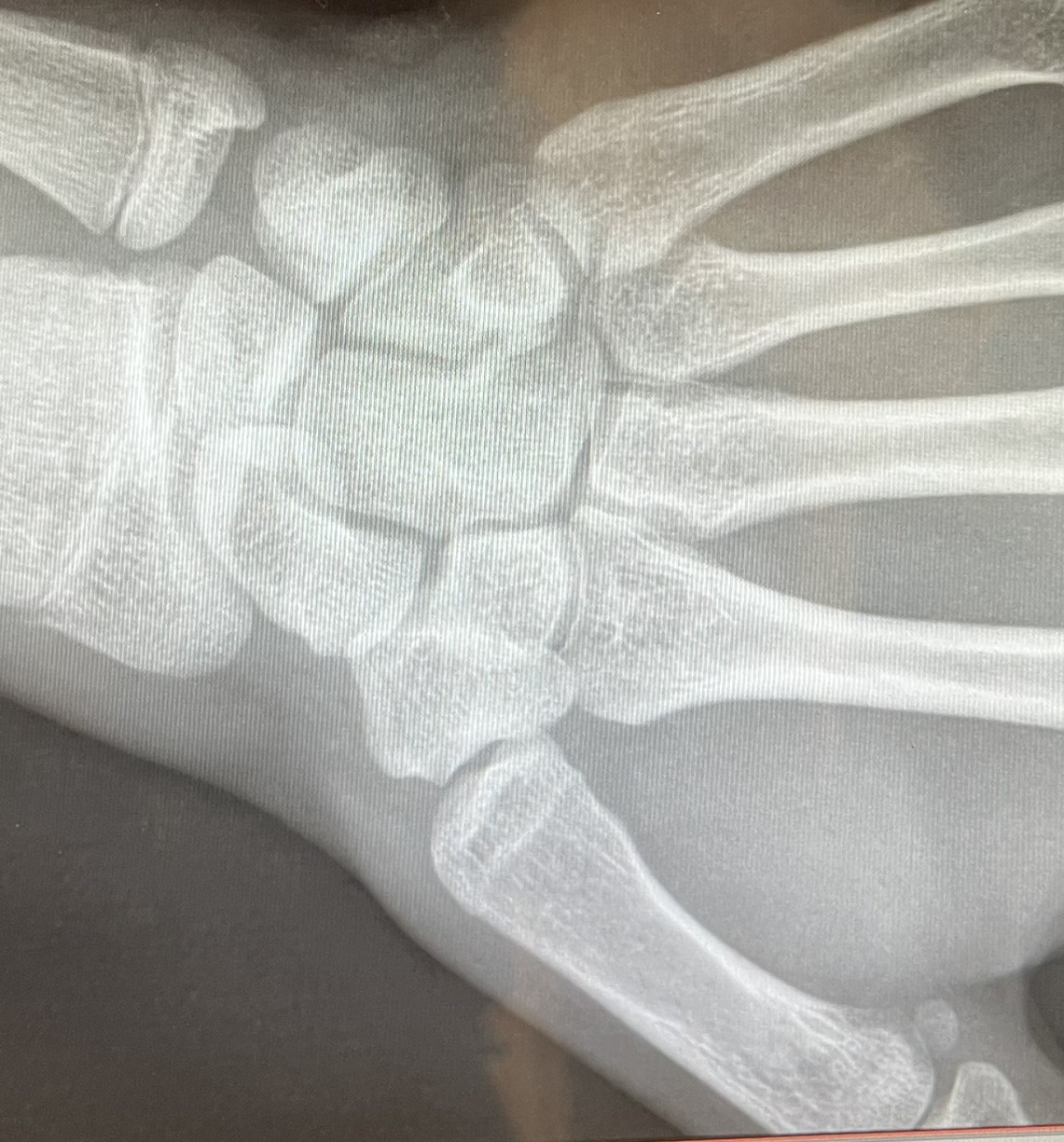 Wrist 1