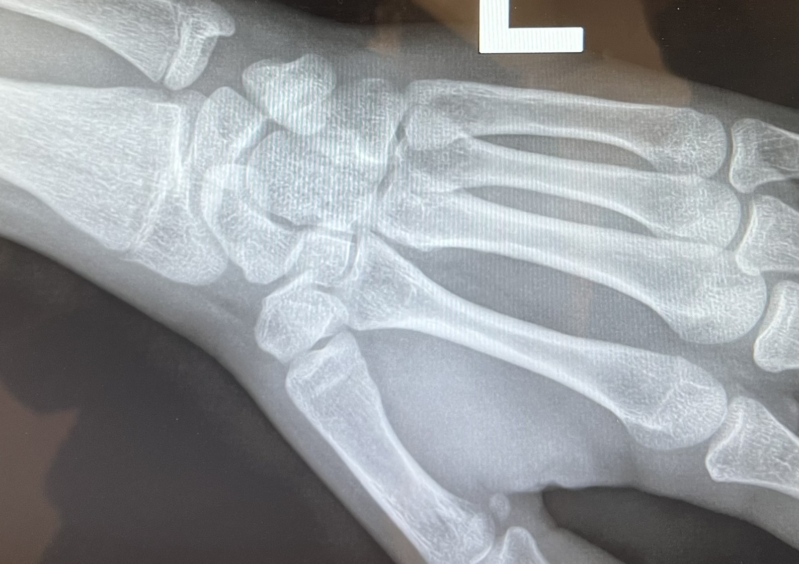 Wrist 2