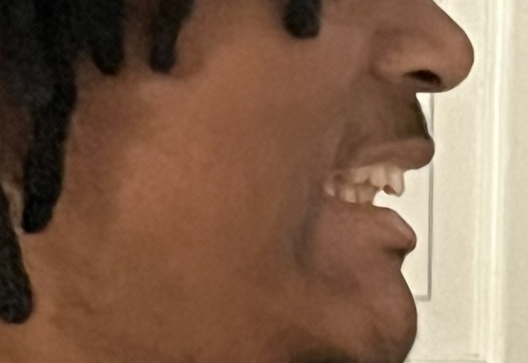 Jaw1