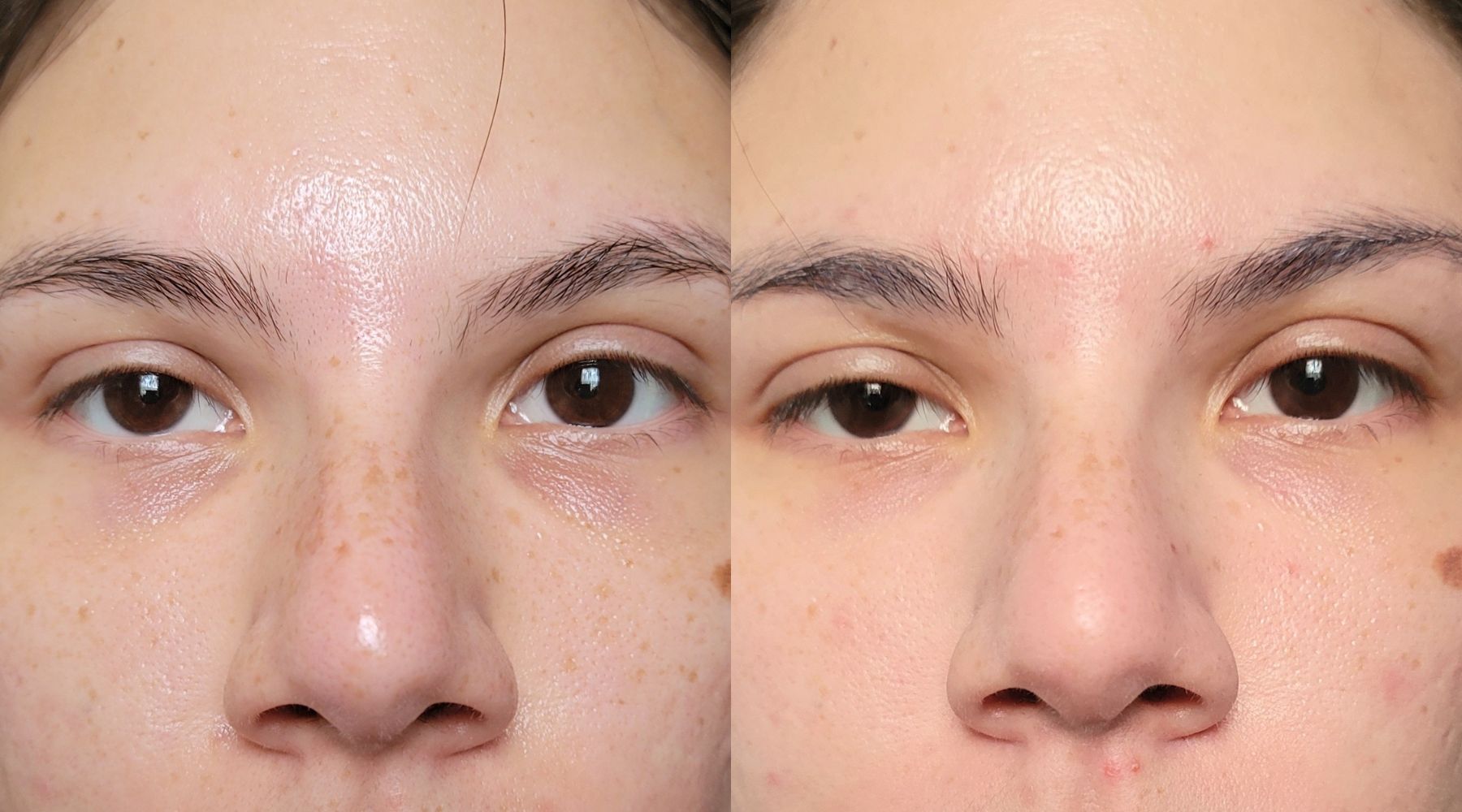 How to get rid of dark circles