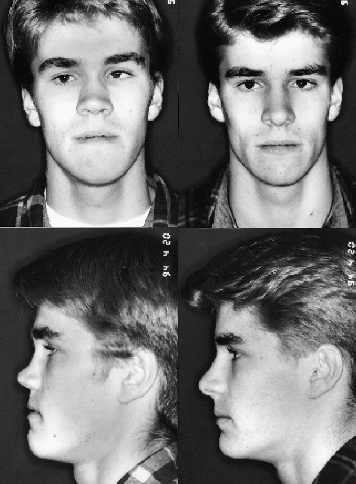 Twin A left and twin B right at 12 years of age