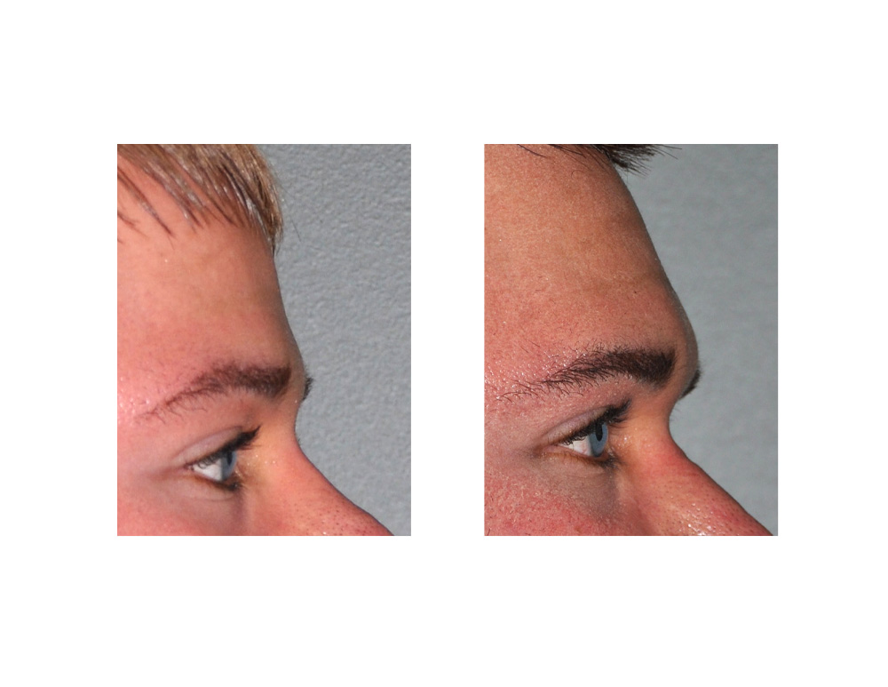 Brow Bone Implant result side Dr Barry Eppley Indianapolis