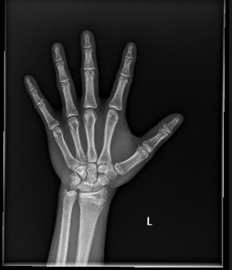 Bone age xray