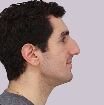 Big nose from the side