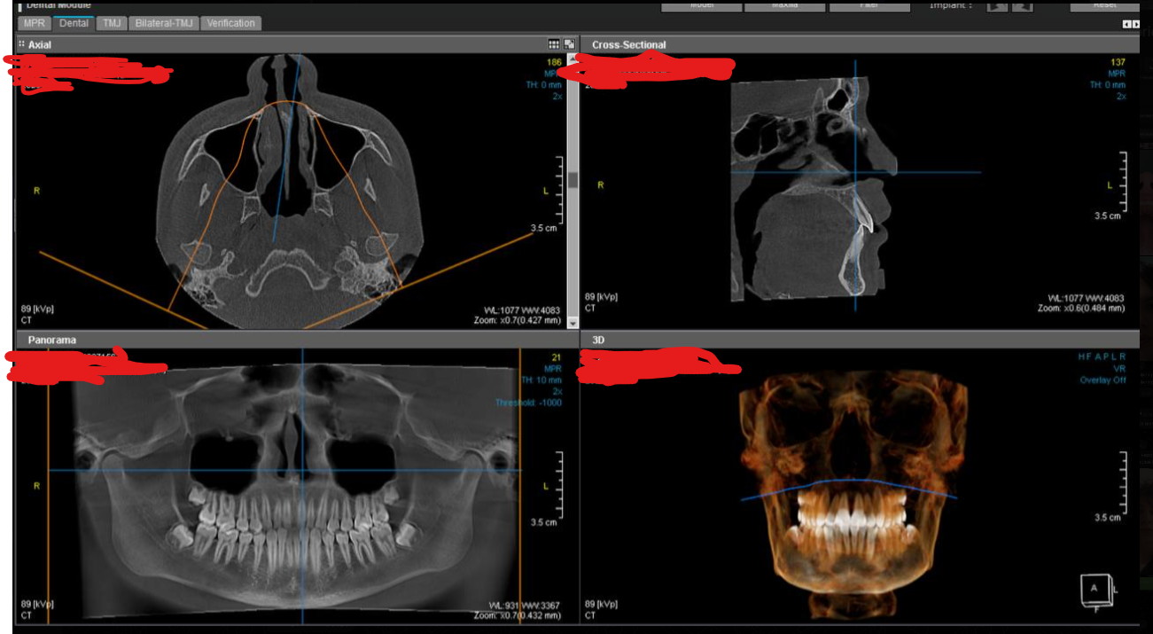 Xray
