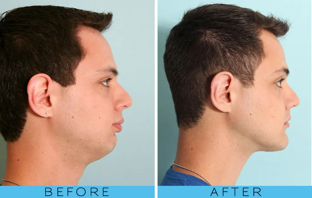 Jaw surgery before after overbite