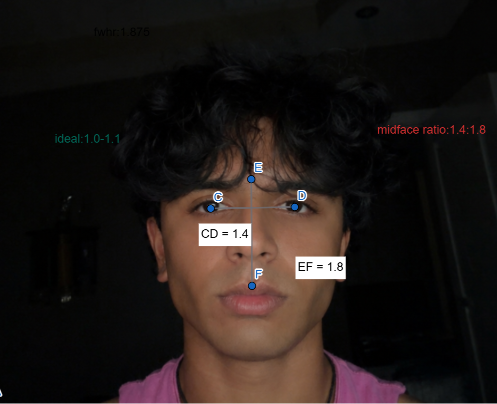 Midface ratio