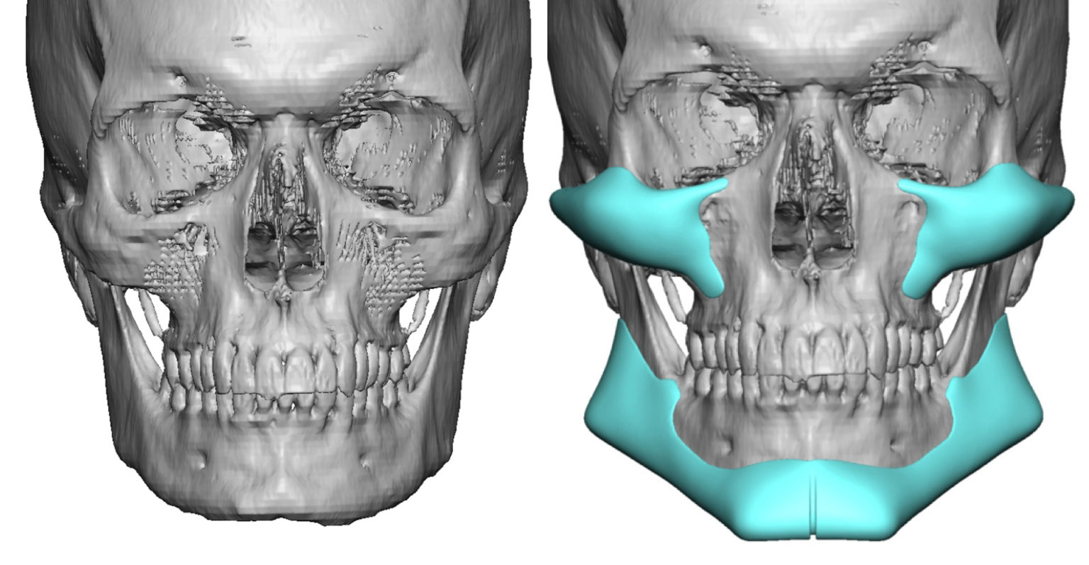 4 Strong Male Cheek and Jawline Implant design front view Dr Barry Eppley Indianapolis 1024x532