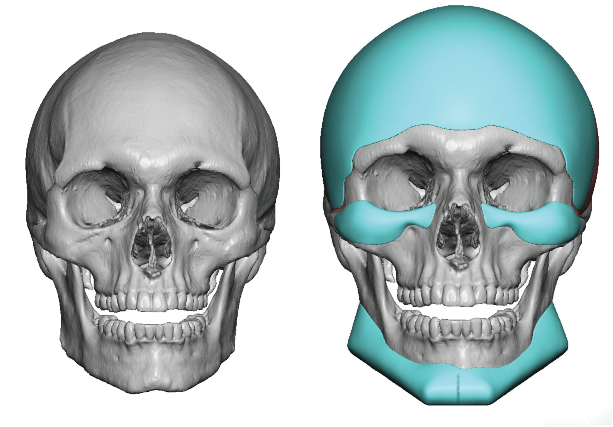 Custom Forehead Infraorbital Malar and Jawline Implant deeigns front view Dr Barry Eppley 1 20