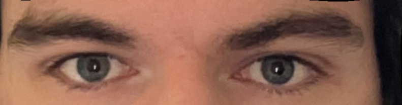Chadly brow