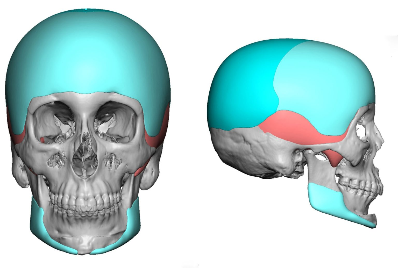 3 Custom Jaw Angle Implants to blend into sliding genioplasty done at the asme time along with