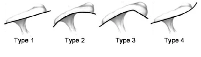 Acromiontypes