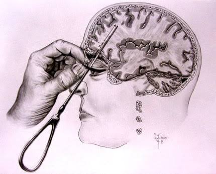 Lobotomy