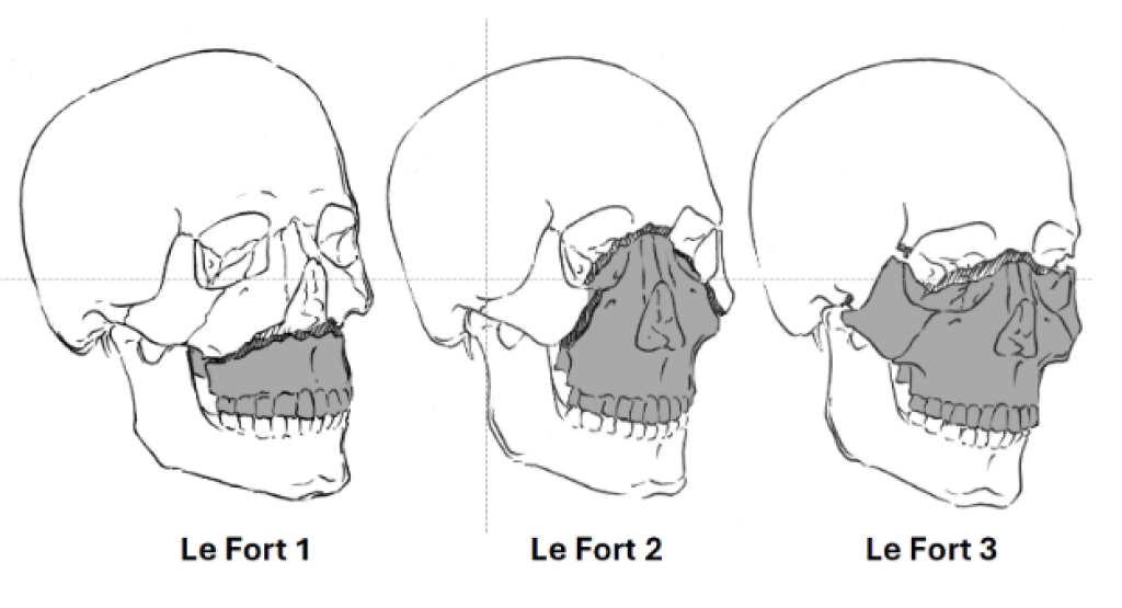 LeFortOsteotomy
