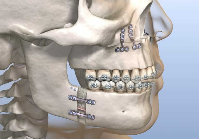 Mandibular advancement surgery 768x537
