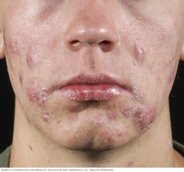 47 cysticacne 8col