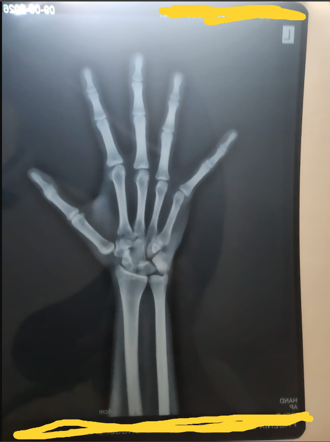 Wrist x ray left cens
