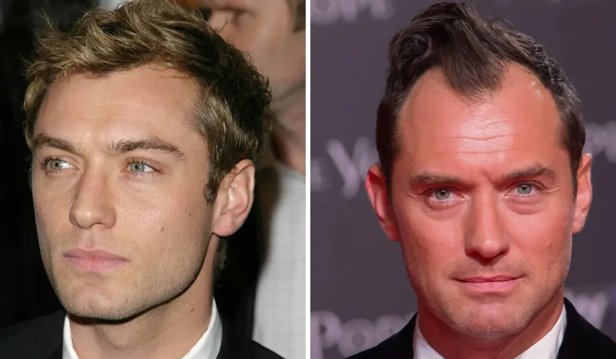 Jude Law Hair Transplant 3
