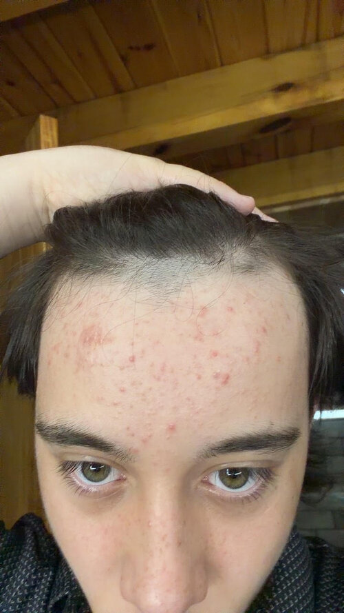 acne looksmax.jpg