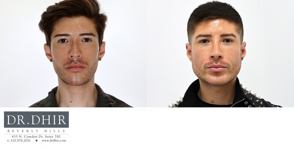 facial-implants-pt-1a.jpg