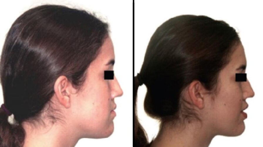 recessed-maxilla-result-2.jpeg