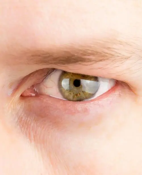 Condition-Ptosis-2-600x739.jpg.webp